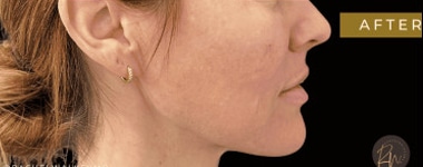 After Image: Case #6565 – SAFELipo on her neck with Renuvion skin tightening - right-side