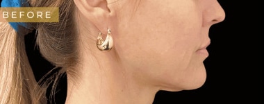 Before Image: Case #6565 – SAFELipo on her neck with Renuvion skin tightening - right-side
