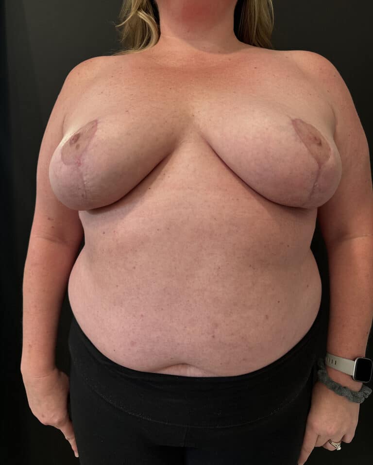 After Image: Case #8103 – Breast Reduction, Liposuction - front