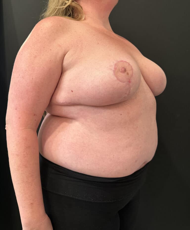 After Image: Case #8103 – Breast Reduction, Liposuction - right-front-oblique