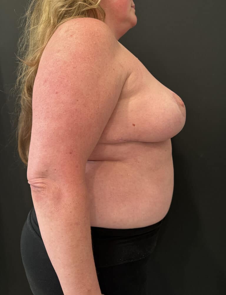 After Image: Case #8103 – Breast Reduction, Liposuction - right-side