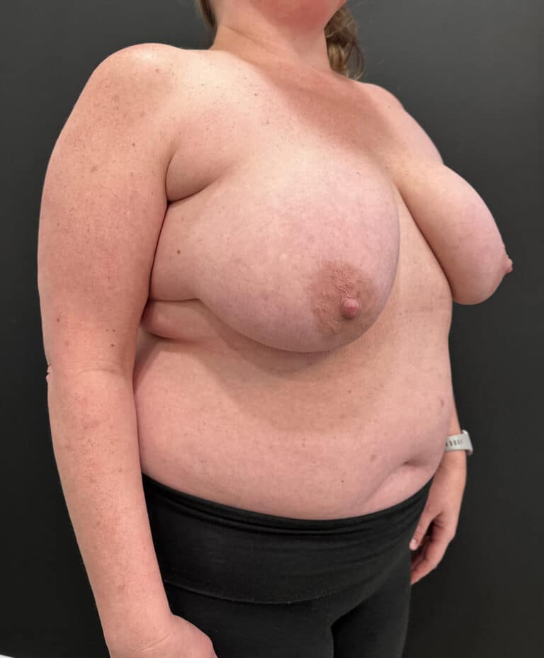 Before Image: Case #8103 – Breast Reduction, Liposuction - right-front-oblique