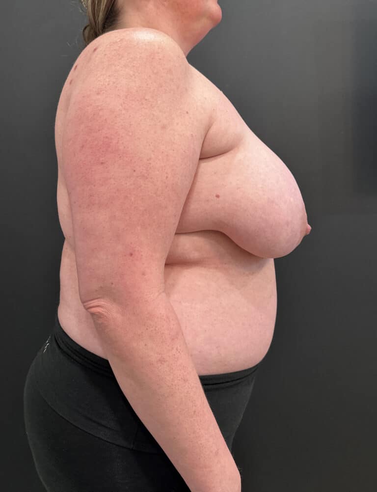 Before Image: Case #8103 – Breast Reduction, Liposuction - right-side