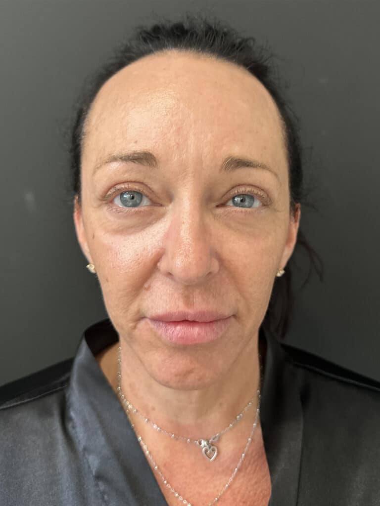 After Image: Case #8158 – Tummy Tuck, Liposuction, Breast Augmentation & Lift , Eyelid Surgery - front
