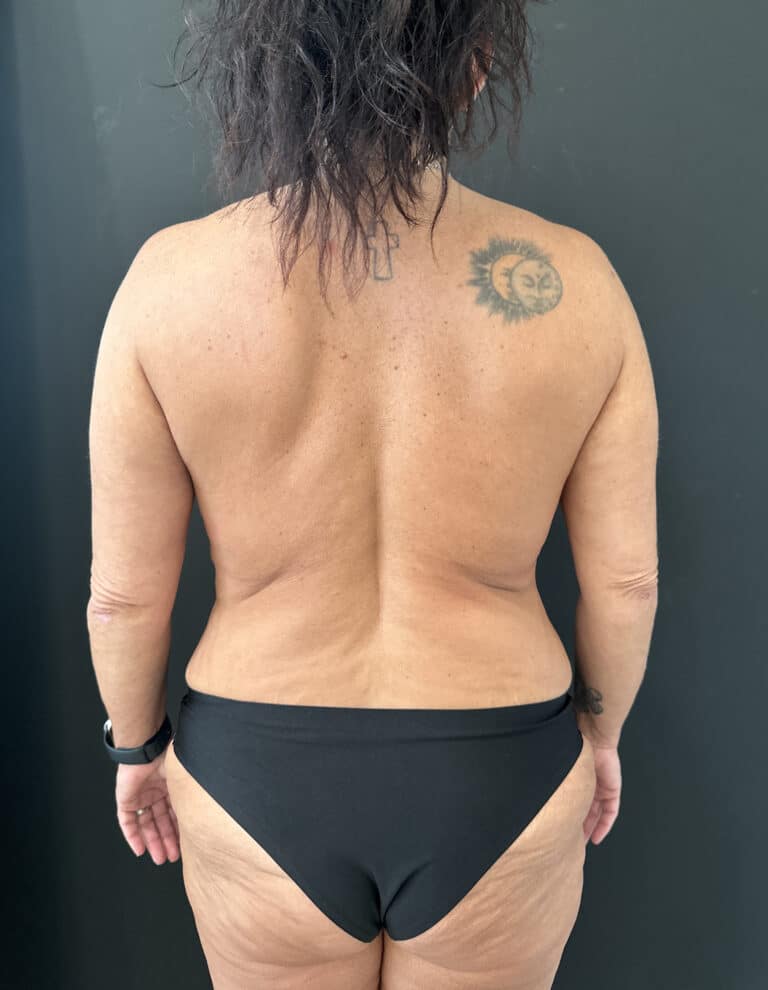 After Image: Case #8158 – Tummy Tuck, Liposuction, Breast Augmentation & Lift , Eyelid Surgery - front