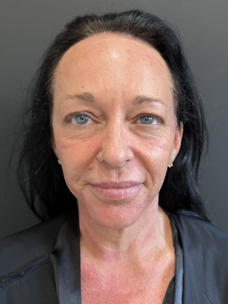 Before Image: Case #8158 – Tummy Tuck, Liposuction, Breast Augmentation & Lift , Eyelid Surgery - front