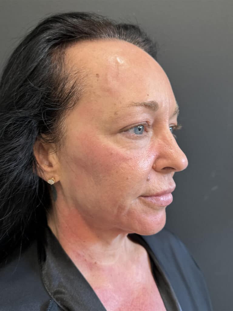 Before Image: Case #8158 – Tummy Tuck, Liposuction, Breast Augmentation & Lift , Eyelid Surgery - right-front-oblique