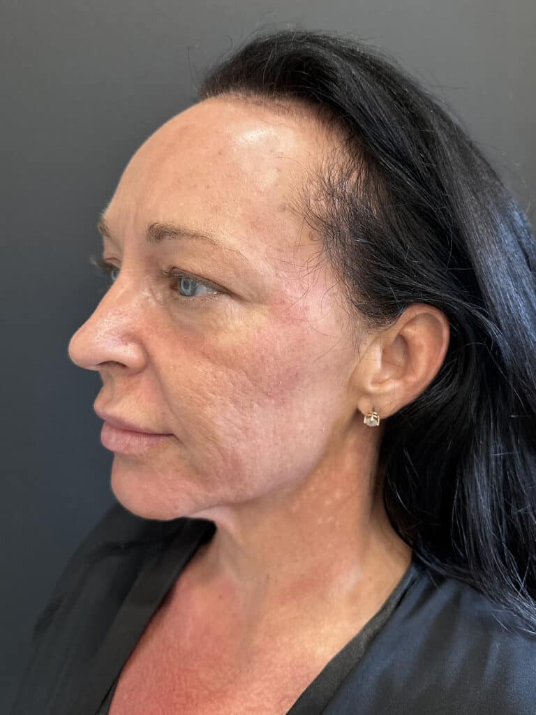 Before Image: Case #8158 – Tummy Tuck, Liposuction, Breast Augmentation & Lift , Eyelid Surgery - left-front-oblique