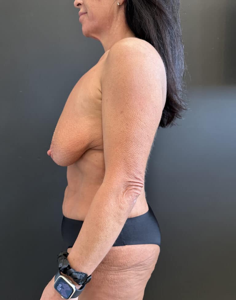 Before Image: Case #8158 – Tummy Tuck, Liposuction, Breast Augmentation & Lift , Eyelid Surgery - left-side