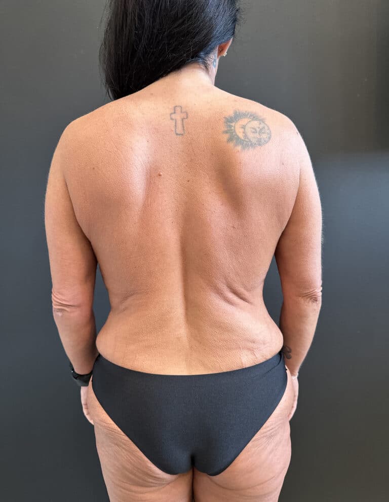 Before Image: Case #8158 – Tummy Tuck, Liposuction, Breast Augmentation & Lift , Eyelid Surgery - front