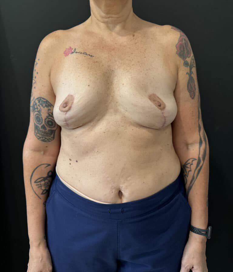 After Image: Case #8113 – Mastopexy with Implant Removal - front
