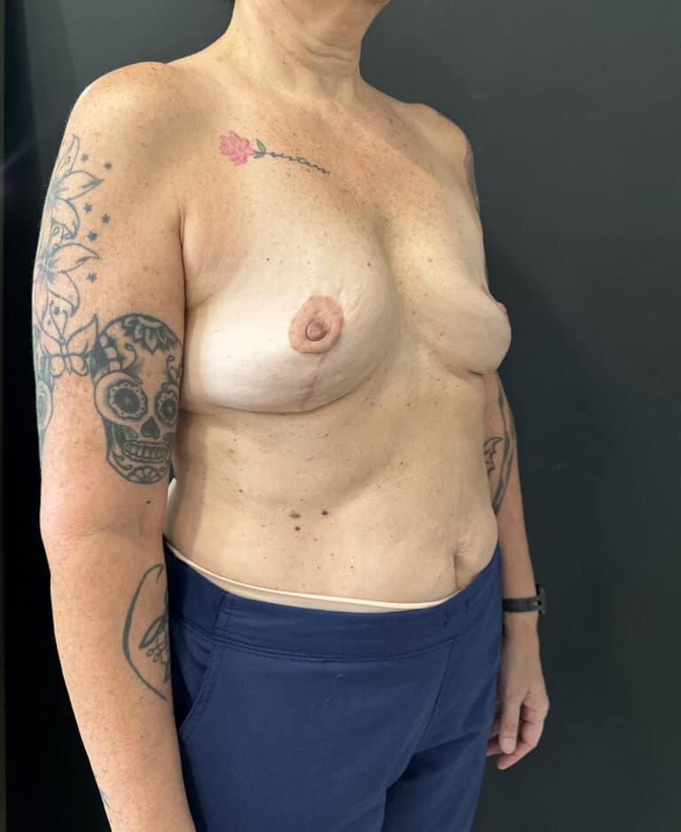After Image: Case #8113 – Mastopexy with Implant Removal - right-front-oblique