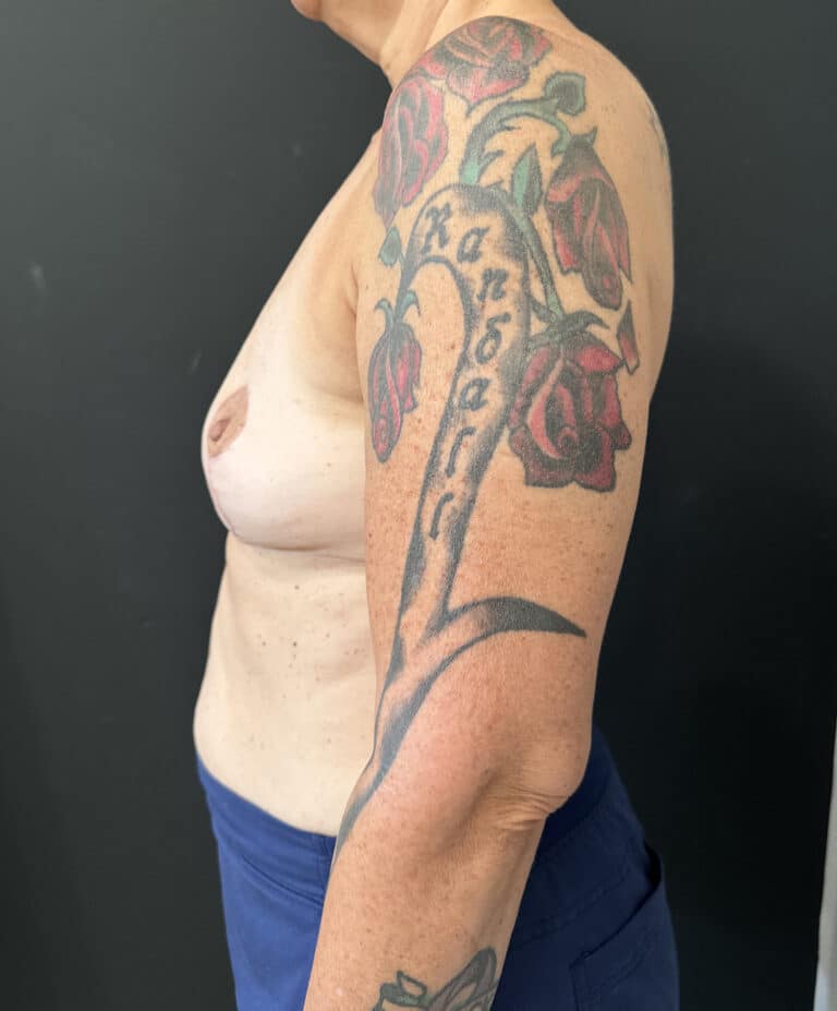 After Image: Case #8113 – Mastopexy with Implant Removal - left-side