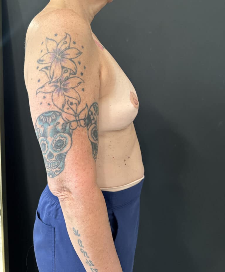 After Image: Case #8113 – Mastopexy with Implant Removal - right-side