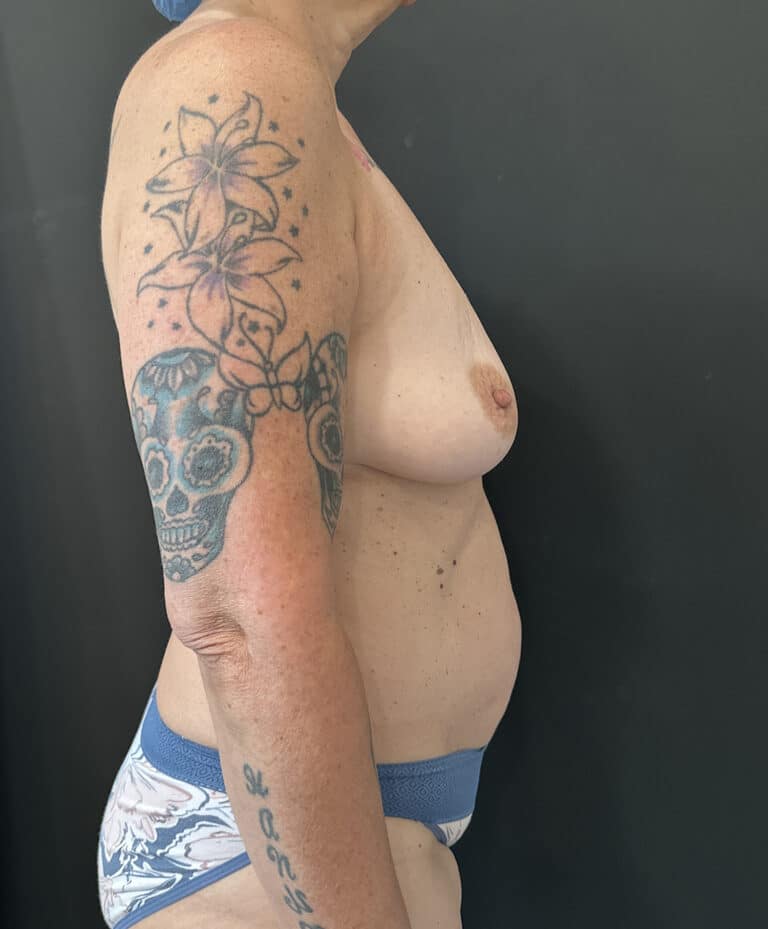 Before Image: Case #8113 – Mastopexy with Implant Removal - right-side