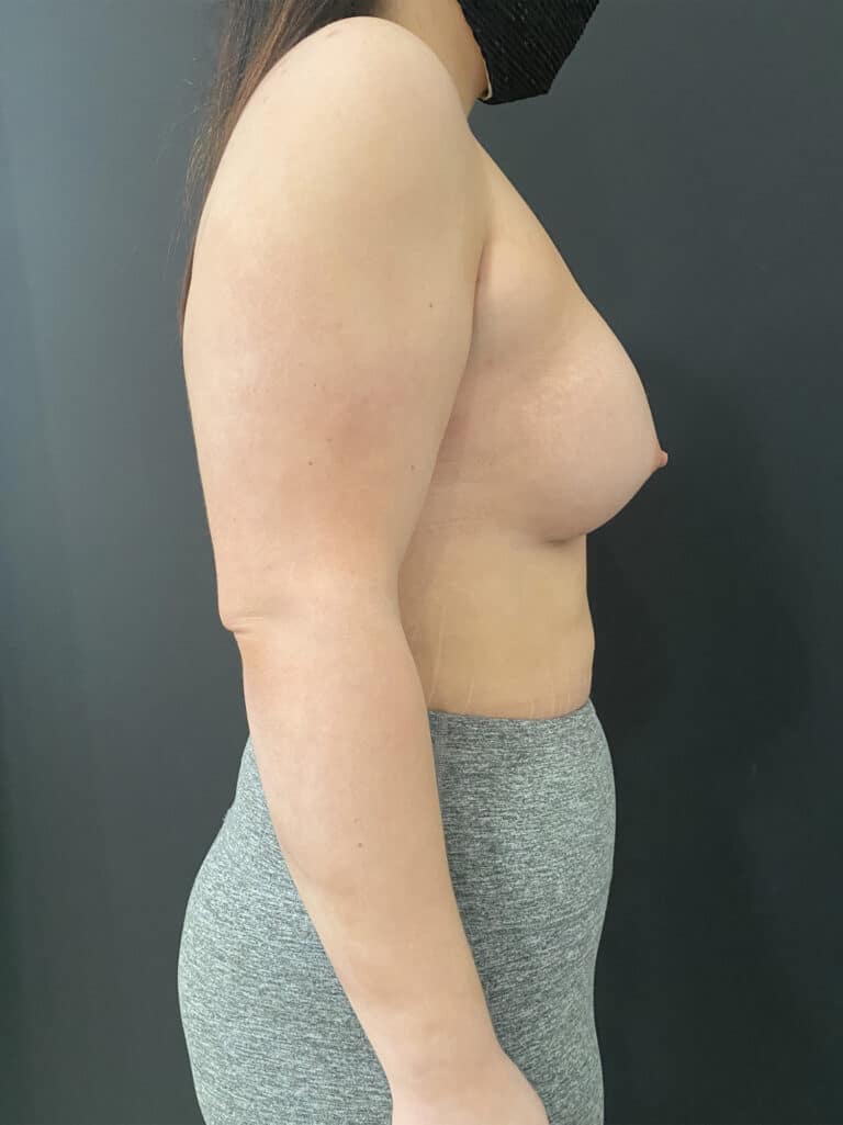 After Image: Case #8138 – Breast Augmentation, SAFElipo - right-side