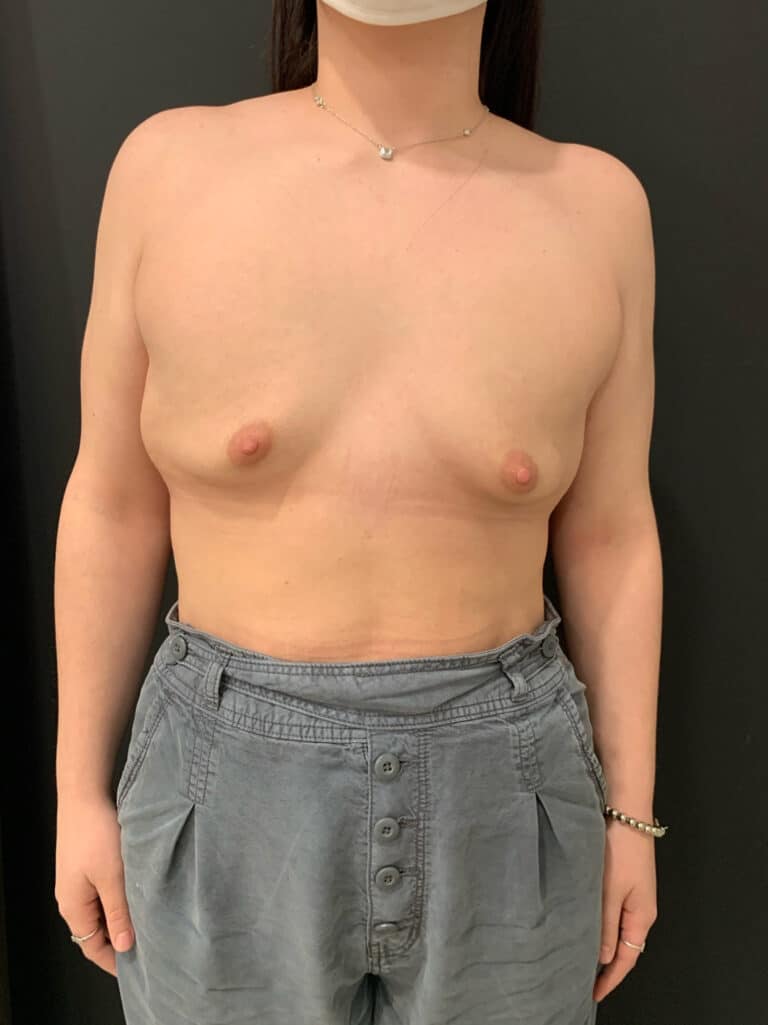 Before Image: Case #8138 – Breast Augmentation, SAFElipo - front