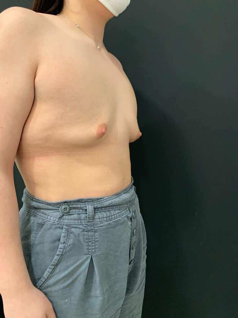 Before Image: Case #8138 – Breast Augmentation, SAFElipo - right-front-oblique