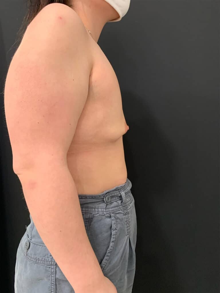 Before Image: Case #8138 – Breast Augmentation, SAFElipo - right-side