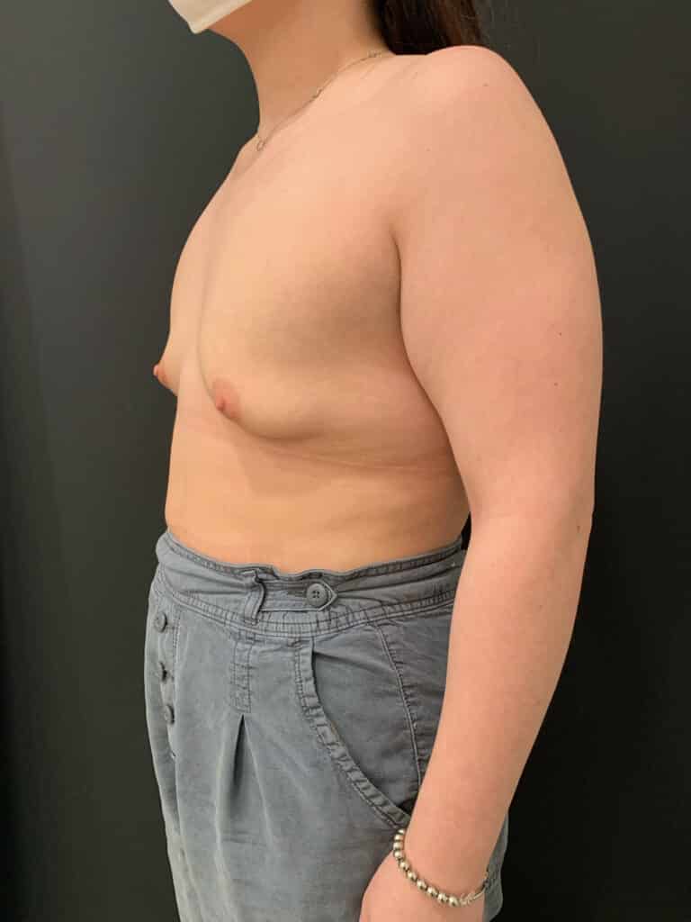 Before Image: Case #8138 – Breast Augmentation, SAFElipo - left-front-oblique