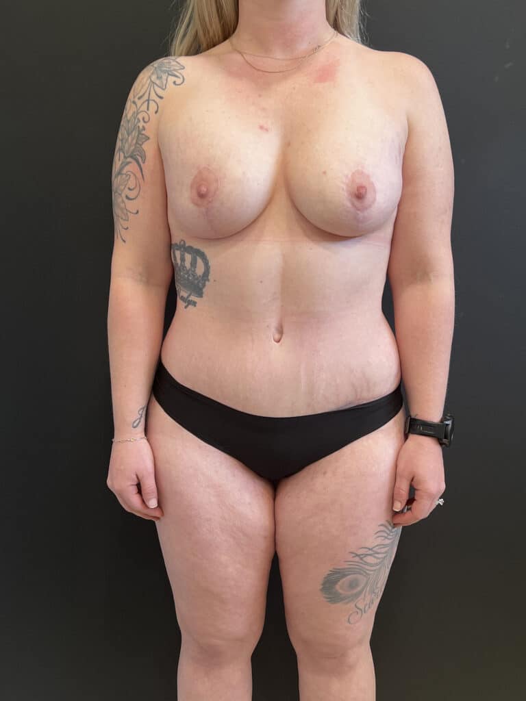 After Image: Case #8149 – Mommy Makeover - front