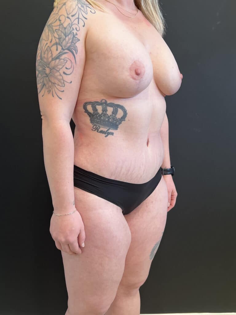 After Image: Case #8149 – Mommy Makeover - right-front-oblique
