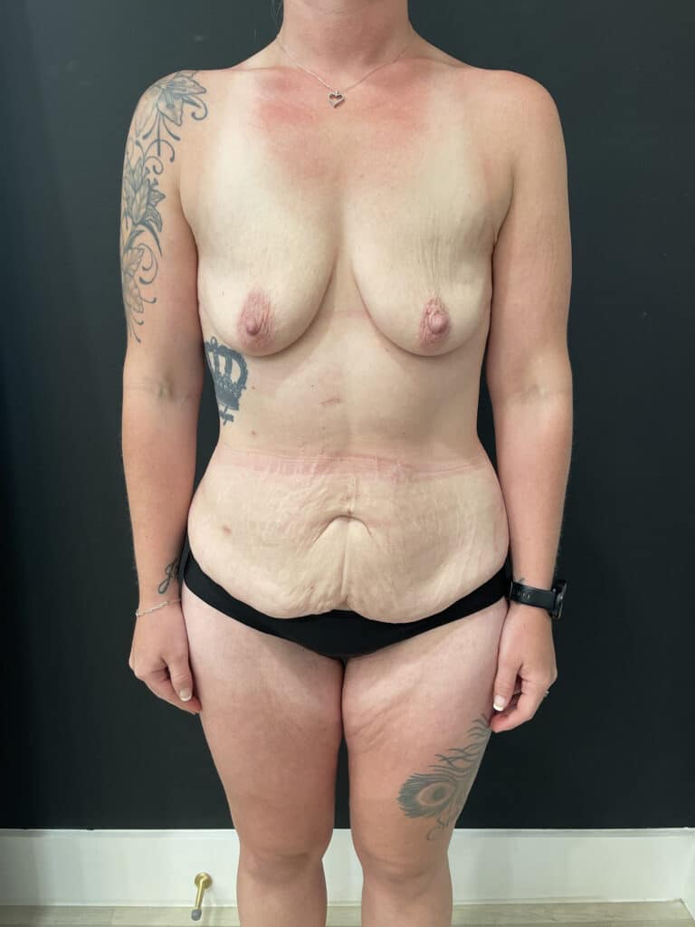 Before Image: Case #8149 – Mommy Makeover - front