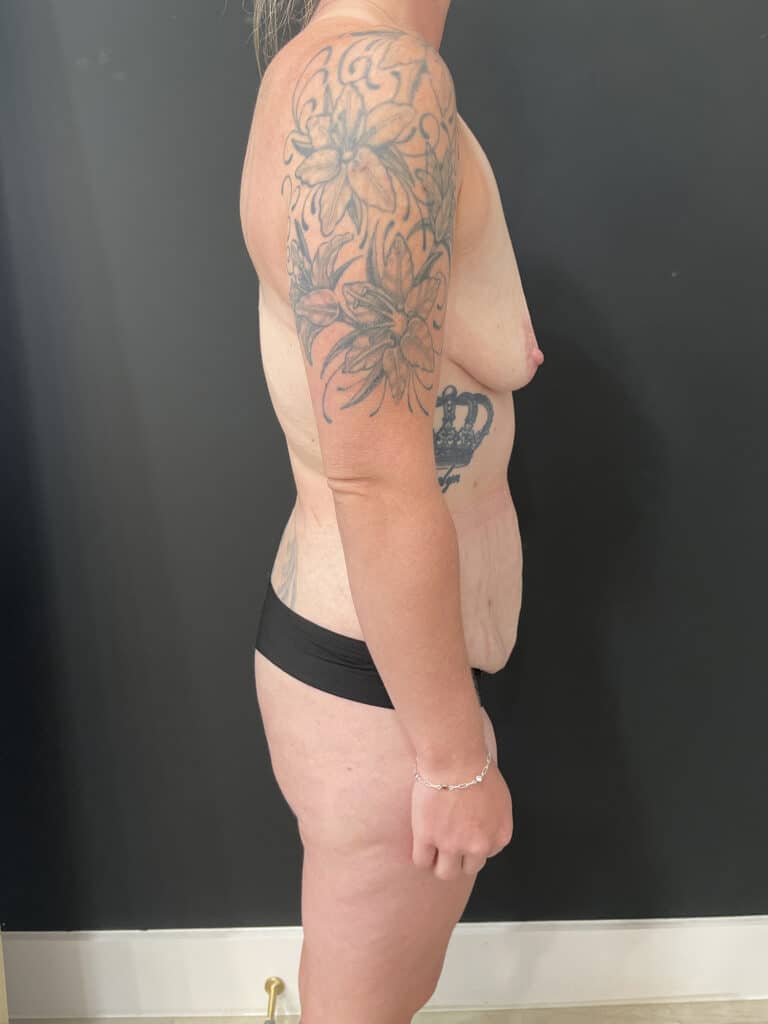 Before Image: Case #8149 – Mommy Makeover - right-side
