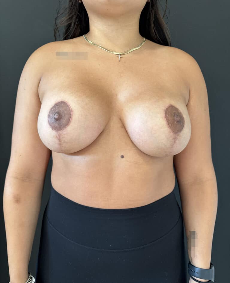 After Image: Case #8177 – Breast Augmentation - front