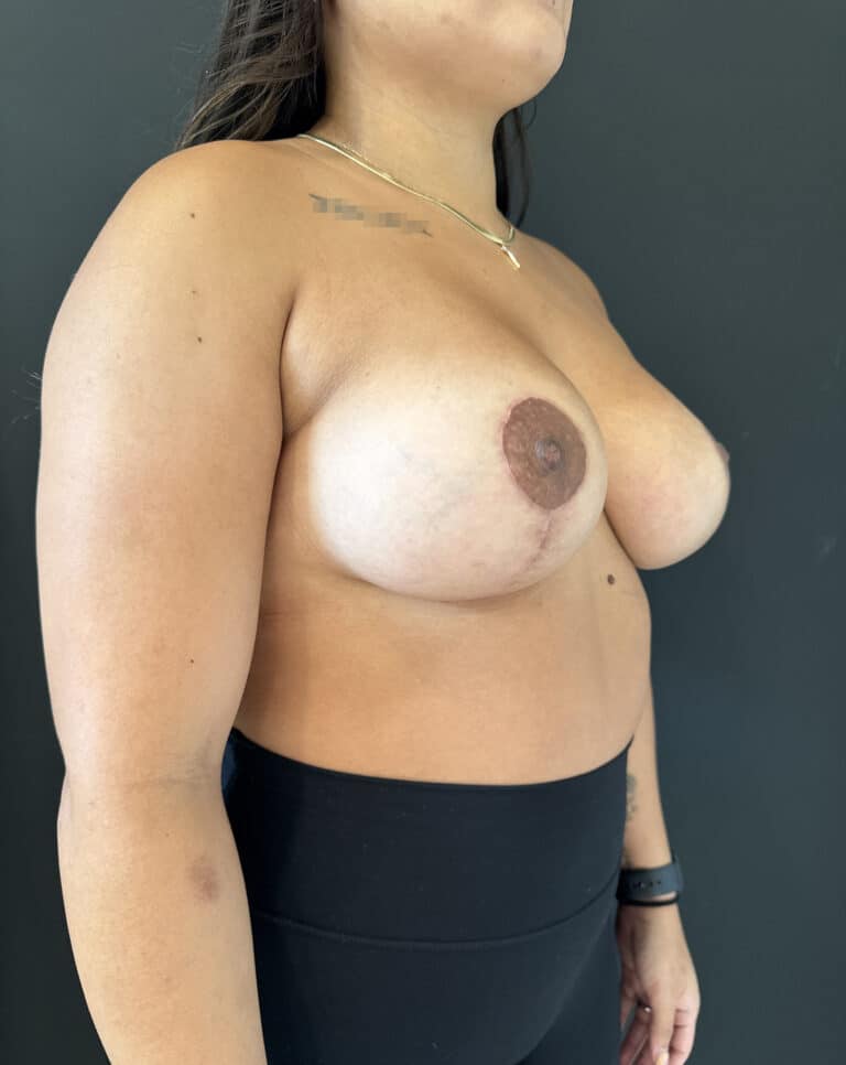 After Image: Case #8177 – Breast Augmentation - right-front-oblique