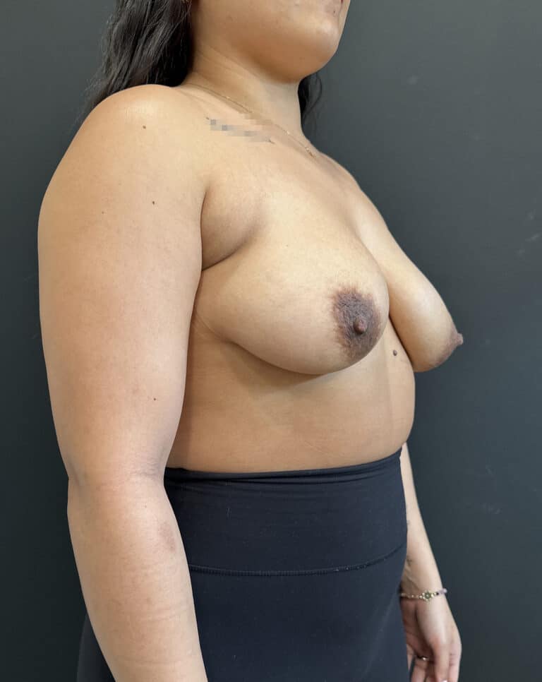 Before Image: Case #8177 – Breast Augmentation - right-front-oblique