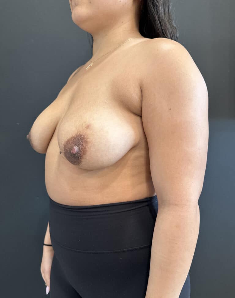 Before Image: Case #8177 – Breast Augmentation - left-front-oblique