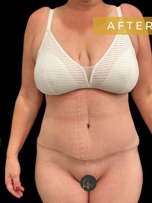 After Image: Case #7077 – Abdominoplasty with SAFELipo of Circumferential Trunk - front