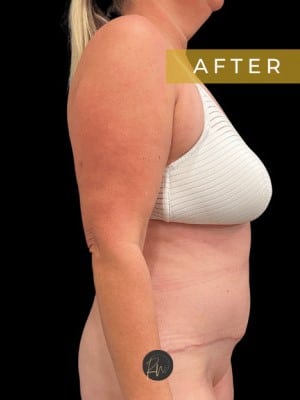 After Image: Case #7077 – Abdominoplasty with SAFELipo of Circumferential Trunk - left-side