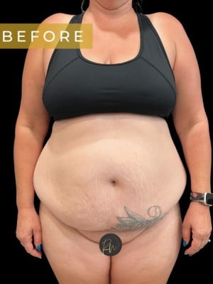 Before Image: Case #7077 – Abdominoplasty with SAFELipo of Circumferential Trunk - front