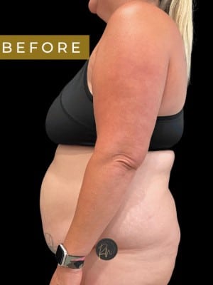 Before Image: Case #7077 – Abdominoplasty with SAFELipo of Circumferential Trunk - left-side