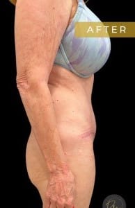 After Image: Case #6618 – Abdominoplasty with SAFELipo of the flanks - right-side
