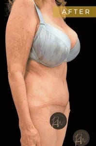 After Image: Case #6618 – Abdominoplasty with SAFELipo of the flanks - right-front-oblique