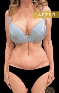 After Image: Case #6618 – Abdominoplasty with SAFELipo of the flanks - front