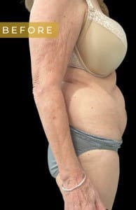 Before Image: Case #6618 – Abdominoplasty with SAFELipo of the flanks - right-side