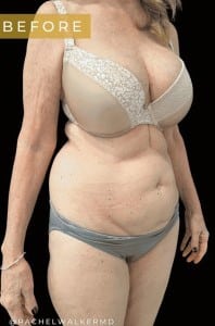 Before Image: Case #6618 – Abdominoplasty with SAFELipo of the flanks - right-front-oblique