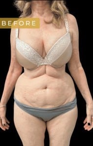 Before Image: Case #6618 – Abdominoplasty with SAFELipo of the flanks - front