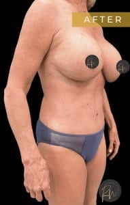 After Image: Case #6713 – Mommy Makeover and Abdominoplasty - right-front-oblique