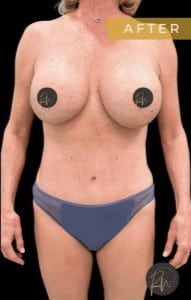 After Image: Case #6713 – Mommy Makeover and Abdominoplasty - front