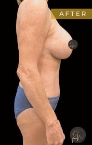 After Image: Case #6713 – Mommy Makeover and Abdominoplasty - right-side