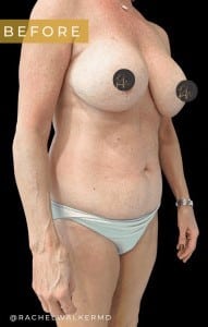 Before Image: Case #6713 – Mommy Makeover and Abdominoplasty - right-front-oblique