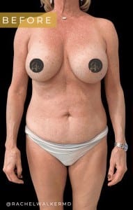 Before Image: Case #6713 – Mommy Makeover and Abdominoplasty - front