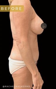 Before Image: Case #6713 – Mommy Makeover and Abdominoplasty - right-side