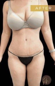 After Image: Case #6722 – Abdominoplasty - front