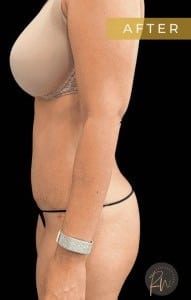 After Image: Case #6722 – Abdominoplasty - left-side